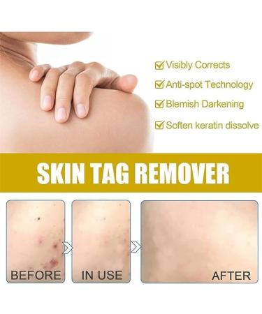 (Must - Have) Super Luxe Skin Re_mover Super Luxe Skin Re_moval Skin Tag Re_mover Cream Painless Mole and Skin Re_mover for All Skin Types (2PC) - Buy Online on GoSupps.com