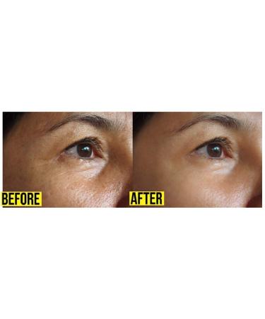 Hoosh Face Wrinkle Pads | 6 Pack Reusable Silicone Patches for Men & Women - Face Lift Mask for Neck, Forehead, Eyes, and Smile Lines Treatment - Buy Online on GoSupps.com
