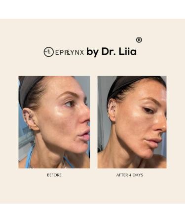 Shop EpiLynx Face Serum for Acne Prone Skin - Vegan Moisturizer for Oily & Sensitive Skin - Gluten Free Solution for Acne Scars - Buy Online on GoSupps.com