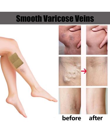 Varicose Veins Relief Patches - Soothe Leg Discomfort & Boost Circulation - 48 PCS | International Shipping Available - Buy Online on GoSupps.com