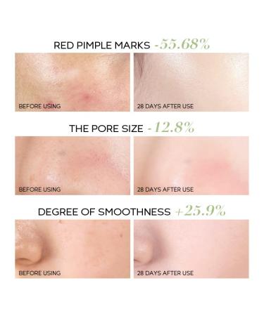 Acne Spot Treatment Serum | Salicylic Acid & Centella | Treat & Prevent Acne for Oily & Combination Skin - Buy Online on GoSupps.com