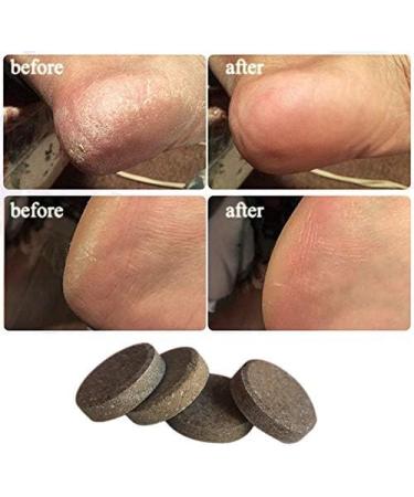 10pcs Ginger Foot Soak Effervescent Tablets Foot Care Mallalah Anti-Swelling Foot Spa Promote Metabolism Eliminate Fatigue Improve Sleeping Foot Pain Foot Care Treatment - Buy Online on GoSupps.com