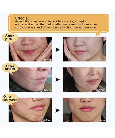 Scar & Acne Marks Removal Ointment Gel (2 Pack) - Skin Repair for Scars Burns Cuts Stretch Marks & Acne Spots - Effective Redness Cream for Face & Body - Buy Online on GoSupps.com