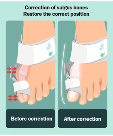 Buy Lmeil Adjustable Orthopedic Bunion Toe Corrector for Men & Women - Foot Care Relief with Silicone Pads (1 Piece) - Buy Online on GoSupps.com