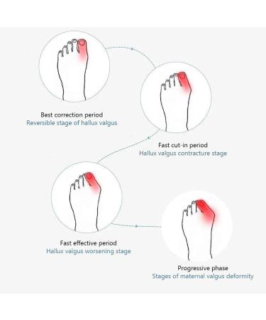 Urisgo Hallux Valgus Correction: Orthopedic Bunion Rail for Great Toe Pain Relief & Support - 2 Pieces for Day/Night Use - Buy Online on GoSupps.com