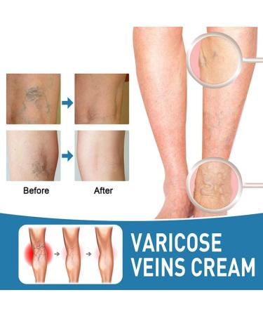 GeRRiT Organic Varicose Vein Treatment Cream Varicose Vein Treatment Varicose Vein Treatment on Legs Reduces Spider Veins and Heaviness - Buy Online on GoSupps.com