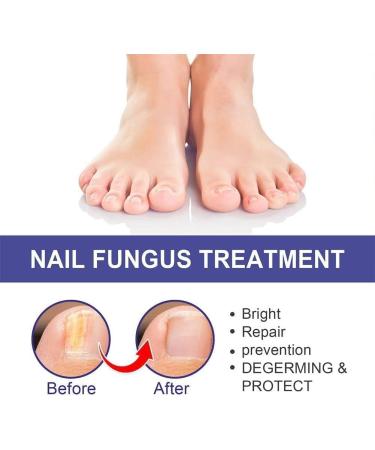 ZERZK 10ml Repair Nail Fungus Treatments Essence Foot Care Nails AntiInfection Toe Fungus Serum Onychomycosis Removal Gel - Buy Online on GoSupps.com