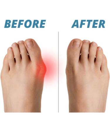 4 Pairs Body Feet Aligner Kit | Orthopedic Bale Correction Gel & Toe Rings for Foot Shape & Pain Relief - Buy Online on GoSupps.com