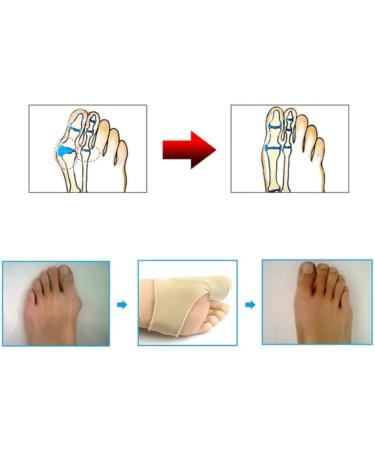 WangNana Silicone Thumb Valgus Toe Cushion - Hallux Relief Corrector Pad Protector Sleeve (1 Pair) - Buy Online on GoSupps.com