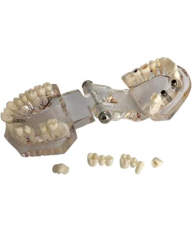 Ziran Dental Disease Implant Teeth Model with Restoration Bridge - Perfect for Medical Science Teaching & Study | High-Quality Resin Model - Buy Online on GoSupps.com