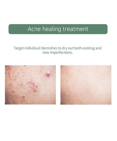 Buy Tea Tree Acne Spot Patches - Salicylic Acid Treatment for Blemishes | 105 Count | Fast International Shipping - Buy Online on GoSupps.com