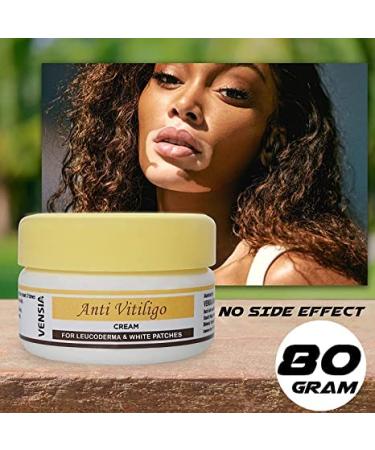MIYUU Anti Vitiligo Cream | Effective Treatment for Vitiligo White Patches & Skin Discoloration | Scar Removal | 80g - Buy Online on GoSupps.com