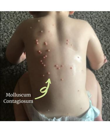 Naturasil for Molluscum - All Natural, Pain-Free Treatment for Children and Adults - Iodine Free - Made in USA | 15ml Bottle - Buy Online on GoSupps.com