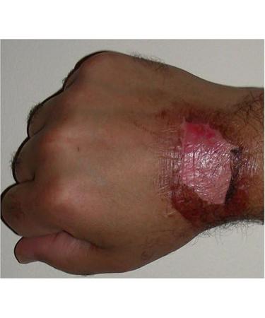 Avosil Scar Care Gel 340.2g | Effective Scar Treatment Solution - Buy Online on GoSupps.com