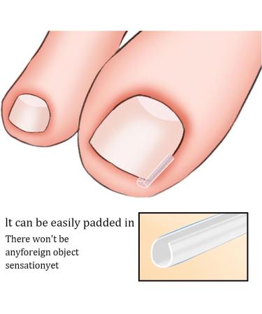 3 Pieces Toenail Straightener Strips Clear Ingrown Toenail Corrector Ingrown Toenail Groove for Women Men Nail Treatment Pedicure Tool - Buy Online on GoSupps.com