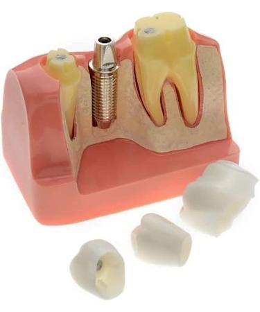 Samnuerly Dental Implant Model | 4-Way Analysis & Training Tool for Crown & Bridge Demonstration - International Shipping Available - Buy Online on GoSupps.com