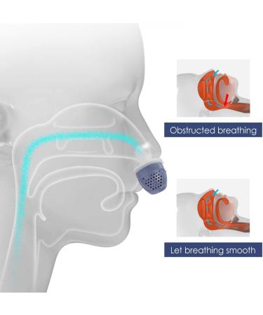 Portable Electric Anti Snoring Device - Sleep Apnea Aid & Snoring Corrector - Buy Online on GoSupps.com