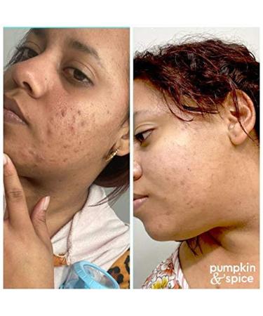 Pumpkin Spice Facial Jelly Cleanser - Natural Makeup Remover & Acne Treatment for All Skin Types - 5 fl oz - Buy Online on GoSupps.com