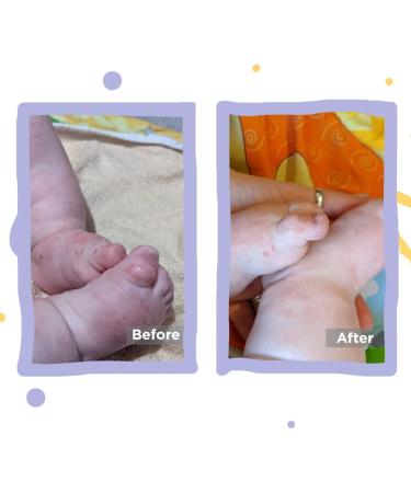 Eczema Baby Leggings | Moisturizing Skin Relief | for Babies 18-24 Months | White - Buy Online on GoSupps.com