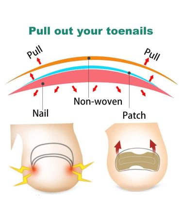Ingrown Toenail Corrector Patch - 50PCS Natural Strips for Painless Treatment and Relief from Nail Groove - Glue-free Solution - Buy Online on GoSupps.com