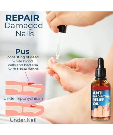 (100% Effective) KYOSK 10ml German Anti Paronychia Relief Oil Anti Paronychia Relief Oil Treatment Repair Paronychia Improve Toenail Health (3pcs) - Buy Online on GoSupps.com