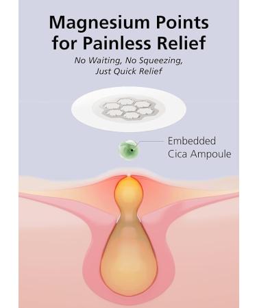 EasyDerm Micro Point Acne Patch Duo 10 Magnesium Pimple Patches + 6 Real Calming Microdart Patches for Breakout & Post-Blemish Care, 2-Step K-Beauty Skincare Kit 1 Count (Pack of 16) Duo Pack - Buy Online on GoSupps.com