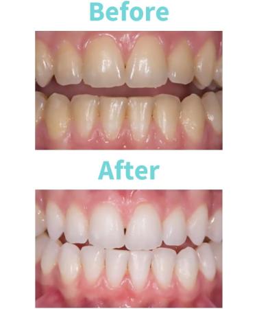 White Dental Beauty Teeth Whitening Gel Refill | 2 x 3ml Syringes | Novon Technology (6% Hydrogen Peroxide) - Buy Online on GoSupps.com