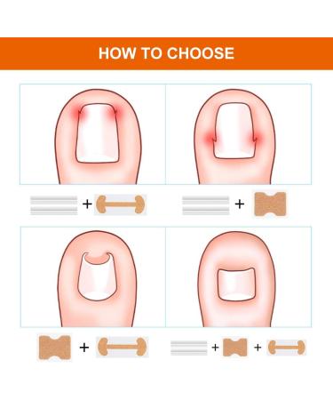 Ingrown Toenails Tool Set Toenail Correction Patch - Buy Online on GoSupps.com