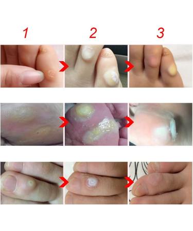 Tgoon Corn Cream Remover Pads - Pain Relief with Liquid | 8.5 * 2.5cm - Buy Online on GoSupps.com