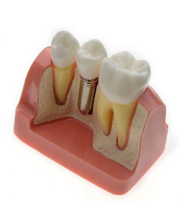 Dental Implant Analysis Demonstration Model - Crown Bridge Teeth Interpretation Model - Buy Online on GoSupps.com