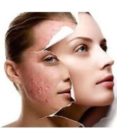 Acne-Aid Liquid Cleanser Oily Skin 100Ml (W) - Buy Online on GoSupps.com