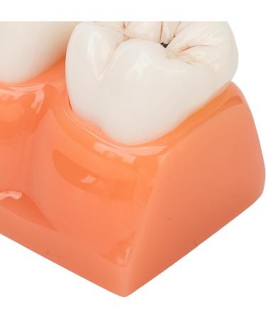 4-Fold Caries Model for Dental Education | Tooth Caries Simulation & Diagnostic Training | Portable for Dentists & Students - Buy Online on GoSupps.com
