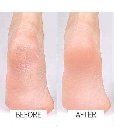 Newbealer Electric Callus Remover & Foot File Kit | Rechargeable, Portable & Powerful | 2-Speed Automatic Vacuum | 6 Grinder Heads Included | Pro Pedi Feet Care - Buy Online on GoSupps.com