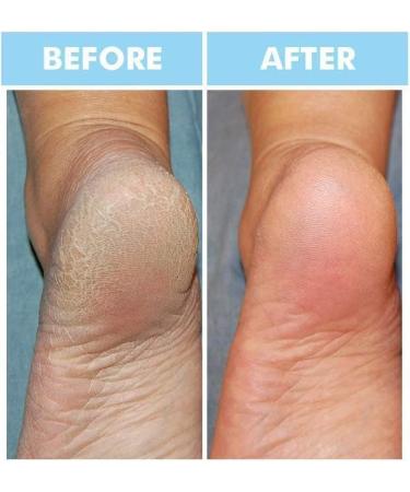 Bodipure Professional Keratin Socks - Moisturizing Foot Mask for Dry Feet - 12 Pairs - Buy Online on GoSupps.com