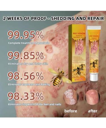 HEKEWER Bee Venom Psoriasis Treatment Cream Set - Soothing Relief for All Skin Types - Buy Online on GoSupps.com