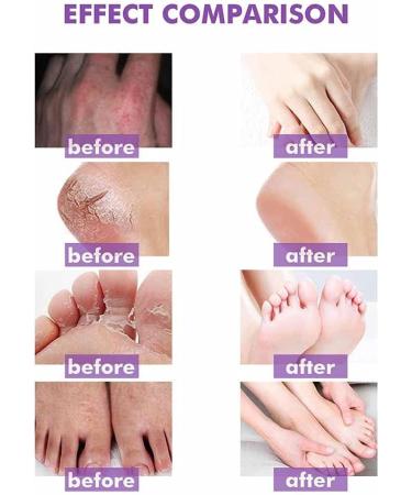 Allbestaye Skin Psoriasis Cream Dermatitis And Eczema Eczema Ointment Treat Dry Itchy And Sensitive Skin Face And Body Care Skin Redness And Rash - Buy Online on GoSupps.com