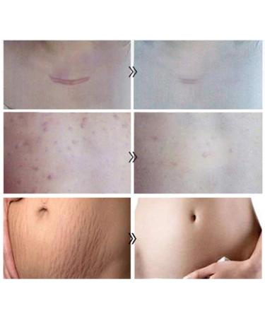 Hotiary Scar Removal Serum - Lavender Repair Essence 30g (1 Pack) - Skin Repair for Cuts, Stretch Marks, Burns & Postoperative Scars - Buy Online on GoSupps.com