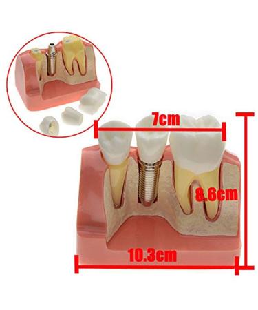 Dental Implant Analysis Demonstration Model - Crown Bridge Teeth Interpretation Model - Buy Online on GoSupps.com