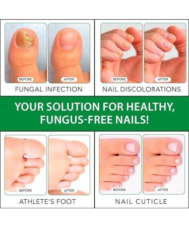 Viking Revolution Toenail Fungus Treatment - Extra Strength 1% Tolnaftate | Tea Tree Oil & Oregano Oil | Athletes Foot & Nail Fungus Remedy (0.5 Fl Oz - Buy Online on GoSupps.com