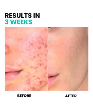 Conatural Niacinamide Serum 30ml | 10% Niacinamide + 1% Zinc - Anti-Aging & Pore Minimizer Serum for Glowing Skin - Buy Online on GoSupps.com