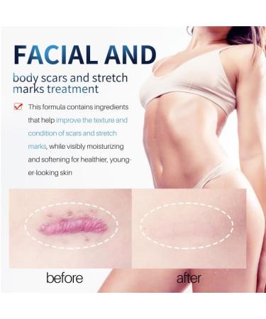 Scar Removal Cream - Repair & Moisturize Old/New Scars, for Male/Female, Surgery/Scald/Burns - 1.85 FL OZ - Buy Online on GoSupps.com