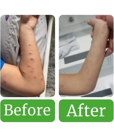 Naturasil Molluscum Treatment Kit - All Natural Homeopathic Solution | Pain-Free for Children and Adults | Made in USA | Includes Topical Liquid & Sulfur Lavender Soap - Buy Online on GoSupps.com