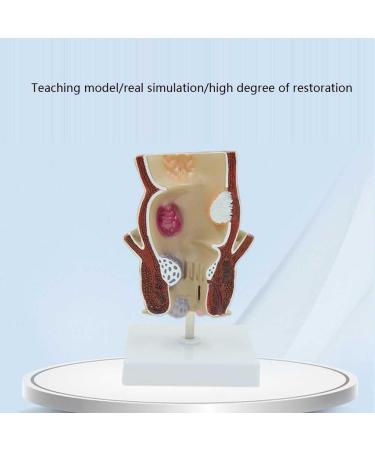 Humanly Rectal Hemorrhoid Lesions Anatomical Model Dilkpunkt Anal Anorectal - Buy Online on GoSupps.com