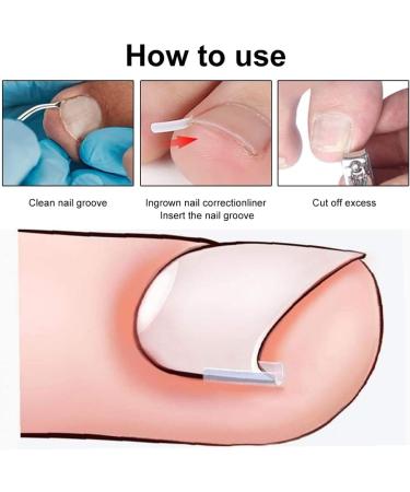 KARELLS Ingrown Toenail Correction Set Ingrown Toenails Set 12 Pieces Ingrown Toenail Lifter Ingrown Toenail Correction Treatment Set for Ingrown Toenails - Buy Online on GoSupps.com