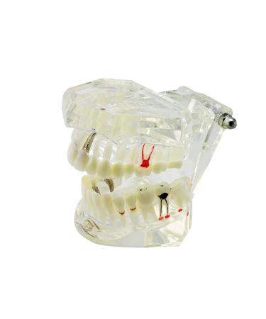 Denshine Dental Implant Disease Teeth Model with Restoration & Bridge Tooth