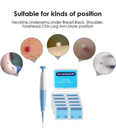 Remove Skin Tag Pen Facial Care Nevus Tool 2mm-4mm Remove Meat Nevus Corns Warts Skin Tag Removal Tool GLFA - Buy Online on GoSupps.com