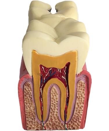 Colcolo Teeth Model - 6X Caries Comparison Examination Models for Study & Research | International Shipping Available - Buy Online on GoSupps.com