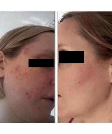 Shop 2-in-1 Facial Brightener Kit | Boost Radiance & Glow - International Shipping Available - Buy Online on GoSupps.com