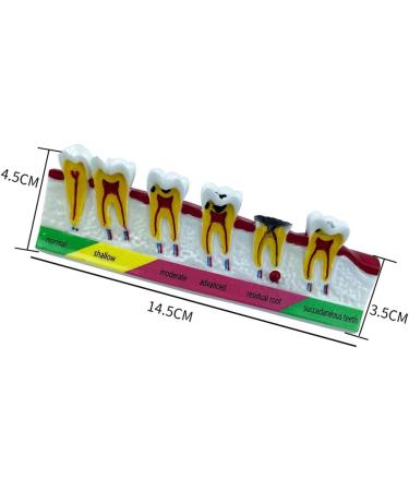 LEYTON Tooth Model for Dental Teaching | Caries Model Enhance Understanding of Pathological Processes | International Shipping Available - Buy Online on GoSupps.com