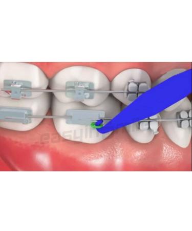 Disposable Dental Elastic Rubber Band Placers for Braces - 10PCS - Buy Online on GoSupps.com